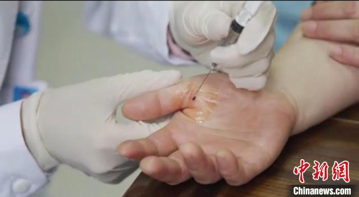 嘉善群眾體驗小針刀?！〖紊平y(tǒng)戰(zhàn) 供圖