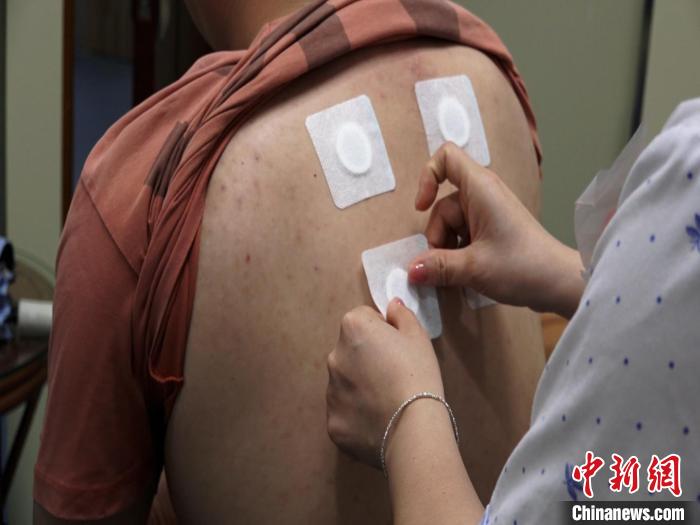 圖為醫(yī)生正在為民眾貼“三伏貼”?！√莆登?攝